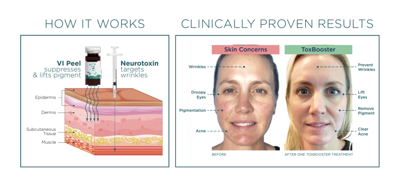 The VI Peel Tox Booster: The Treatment that enhances your Botox results!