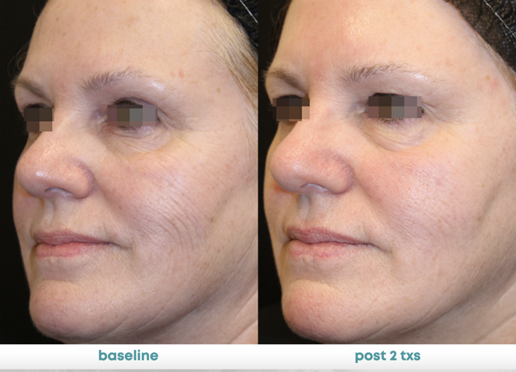 Summer Safe Skin Resurfacing: Achieve Radiant Skin All Year Round