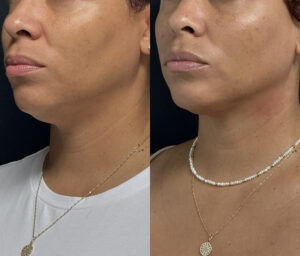 Ultherapy: A Non-Invasive Solution for Skin Tightening and Lifting