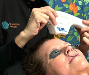 Why BBL Hero Is The Superior Choice Over IPL For Skin Rejuvenation