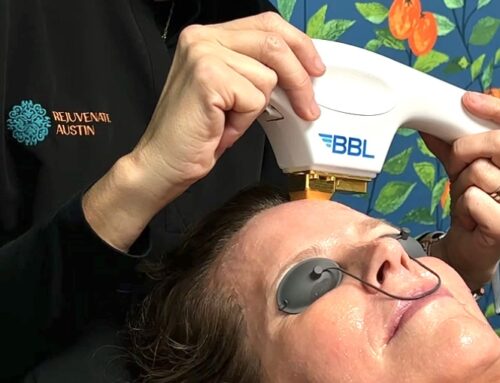 Why BBL Hero Is The Superior Choice Over IPL For Skin Rejuvenation